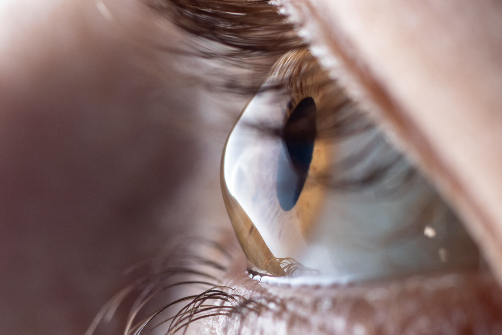 Cheratocono come riconoscere sintomi e cause Emianopsia