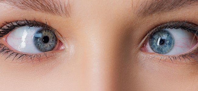 Squint: types, symptoms and treatments