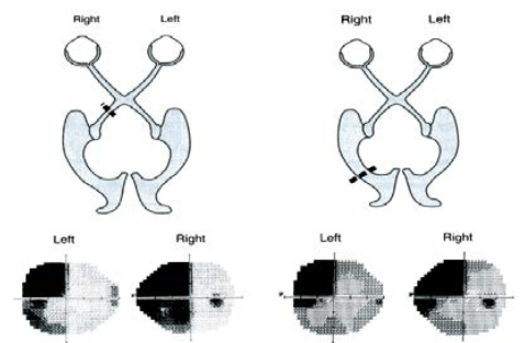 Figura 2 - Emianopsia omonima sinistra