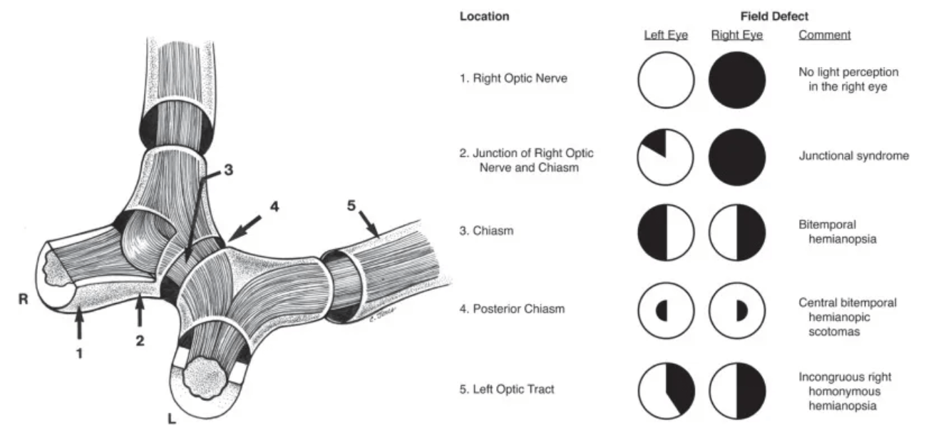 Emianopsia E Patologie Del Chiasma Ottico Emianopsia