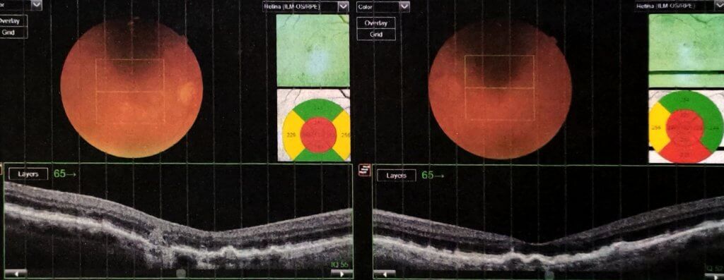 Figura 3 - Tomografia ottica computerizzata (OCT) della maculopatia