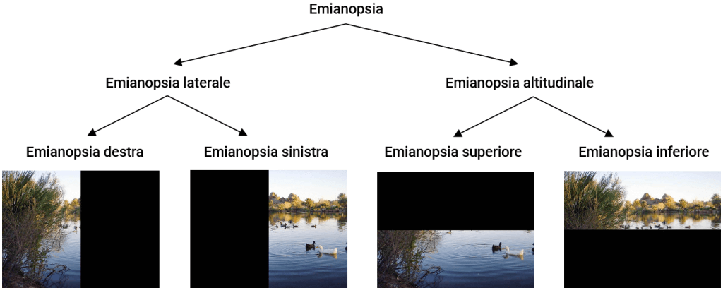 Figura 1 - Schema di classificazione delle emianopsie