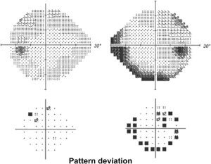 Hemianopia in relation to other pathologies - Emianopsia
