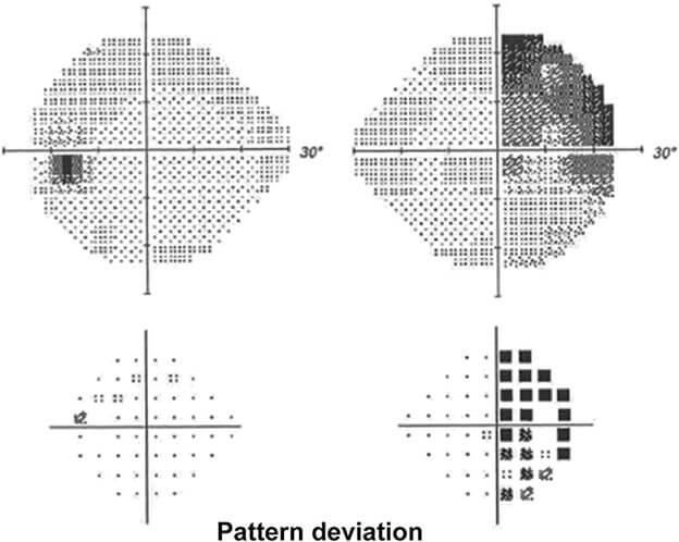 Hemianopia In Relation To Other Pathologies Emianopsia Hemianopia In Relation To Other Pathologies Emianopsia
