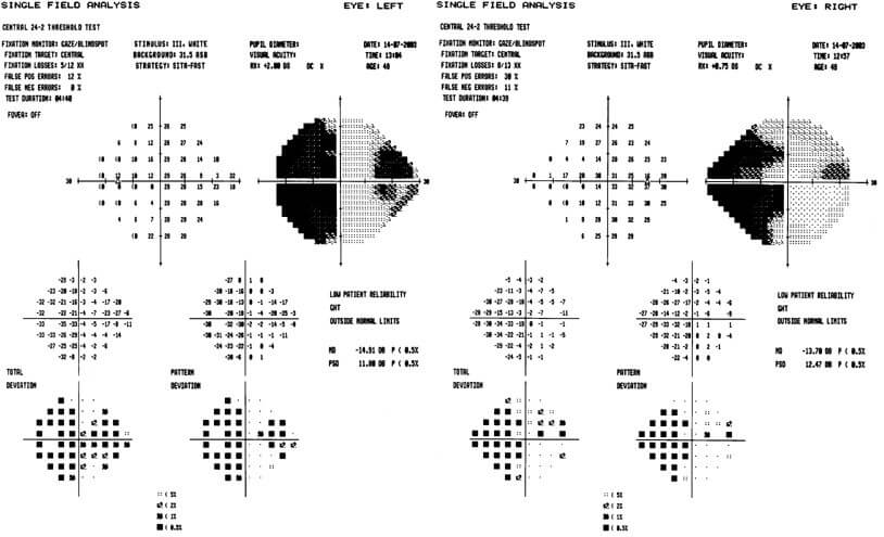 Figura 2. Esame del campo visivo che dimostra la presenza di un difetto del campo emianopico omonimo sinistro ed exotropia concomitante.